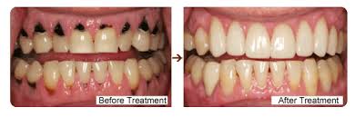 Hollywood Smile Designing in India
